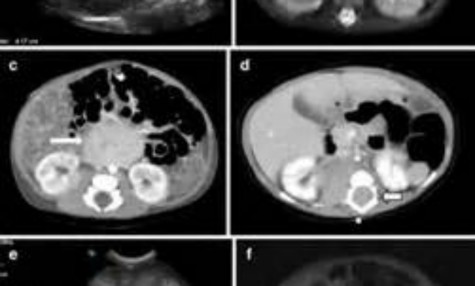 Images of neuroblastoma in the body