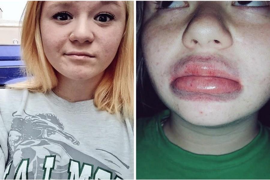 A common result of the Kylie Jenner Challenge